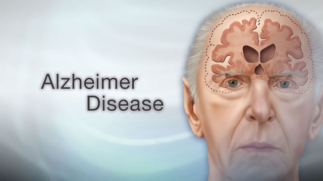 Alzheimer benh suy giam tri nho cua nguoi gia