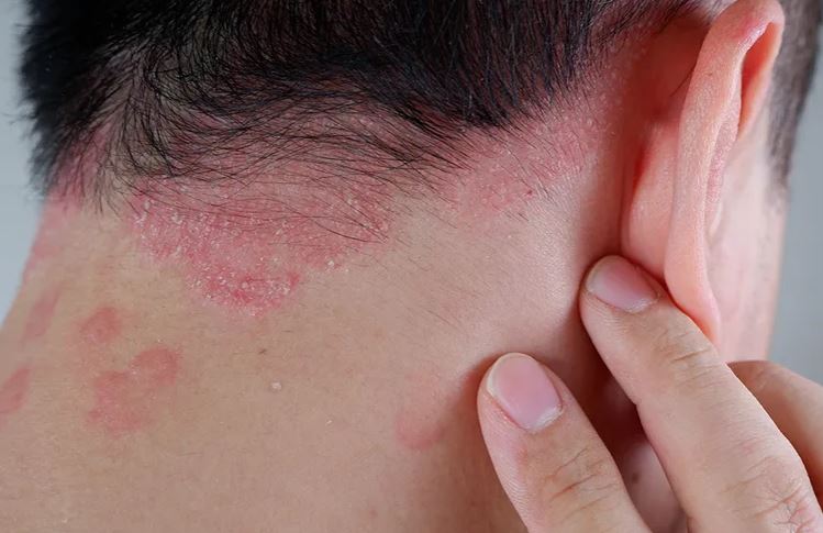 benh vay nen man tinh va dihydroquercetin