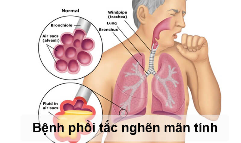 taxifolin _benh-phoi-tac-nghen-man-tinh